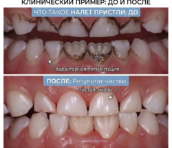 Что такое налёт Пристли: причины, опасность и способы удаления